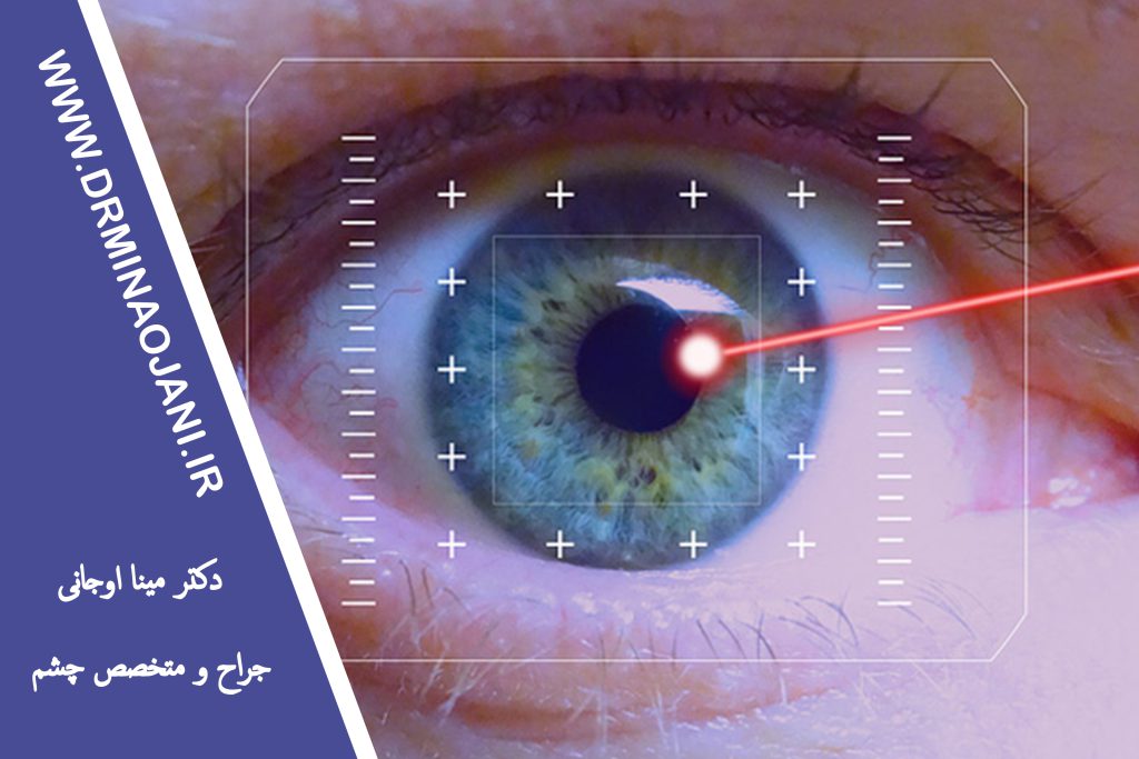 لیزیک