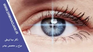 پیشگیری از آستیگماتیسم با روش‌های طبیعی