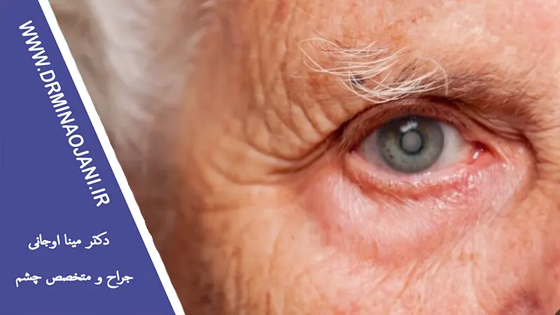 چگونه از ابتلا به آب سیاه چشم پیشگیری کنیم؟