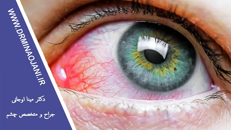 عوامل خطر ابتلا به بیماری‌ های شبکیه چشم